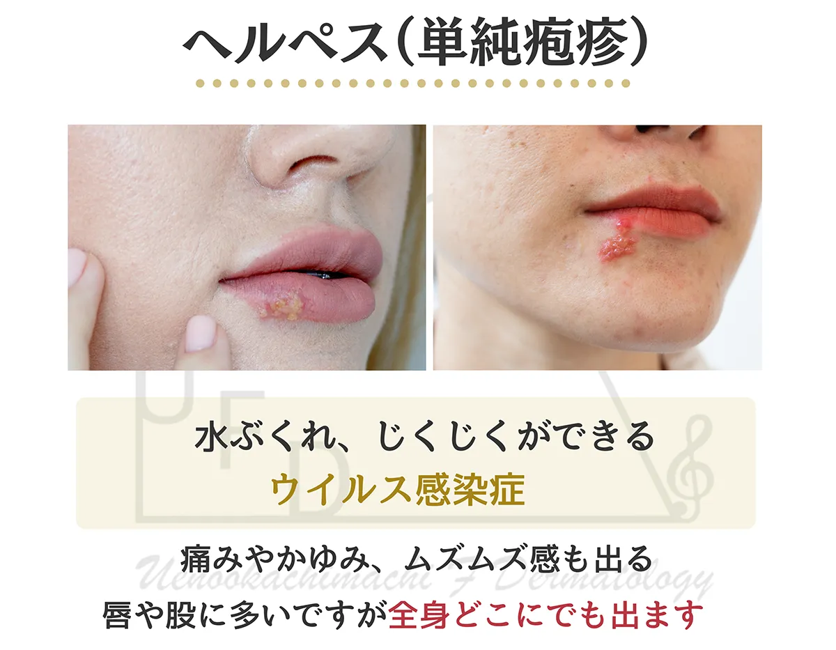 ヘルペス 単純疱疹