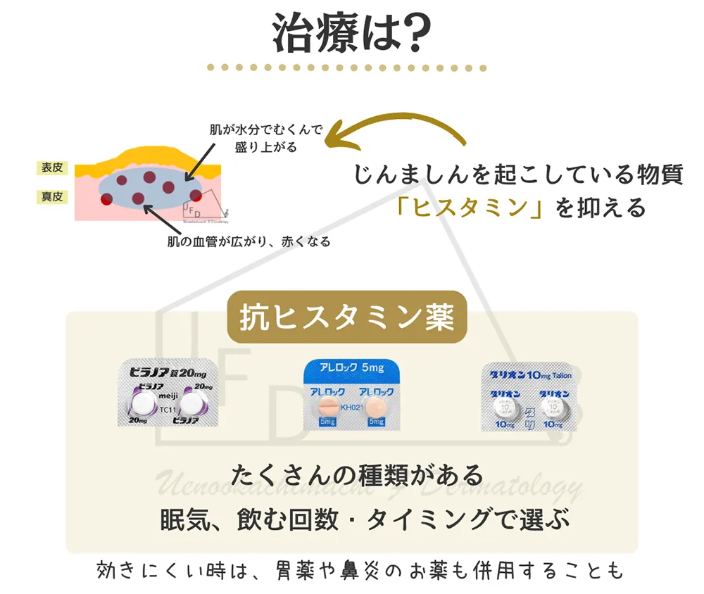 じんましんの治療