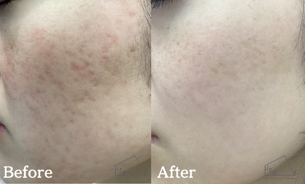 症例2 【20歳代女性】頬のニキビ跡（サブシジョン3回実施）