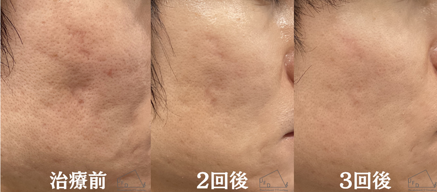 症例１ 【30代男性】頬のニキビ跡（サブシジョン3回施行実施）