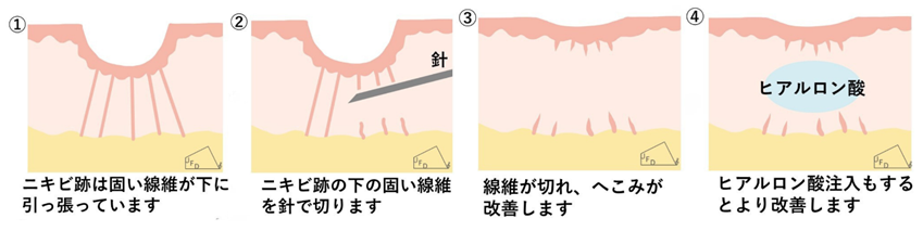 サブシジョンとは？