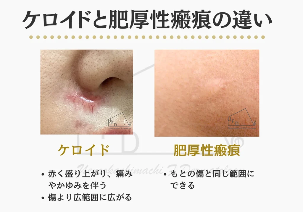 ケロイドと肥厚性瘢痕の治療症例を紹介