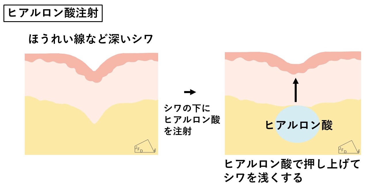 ヒアルロン酸注射