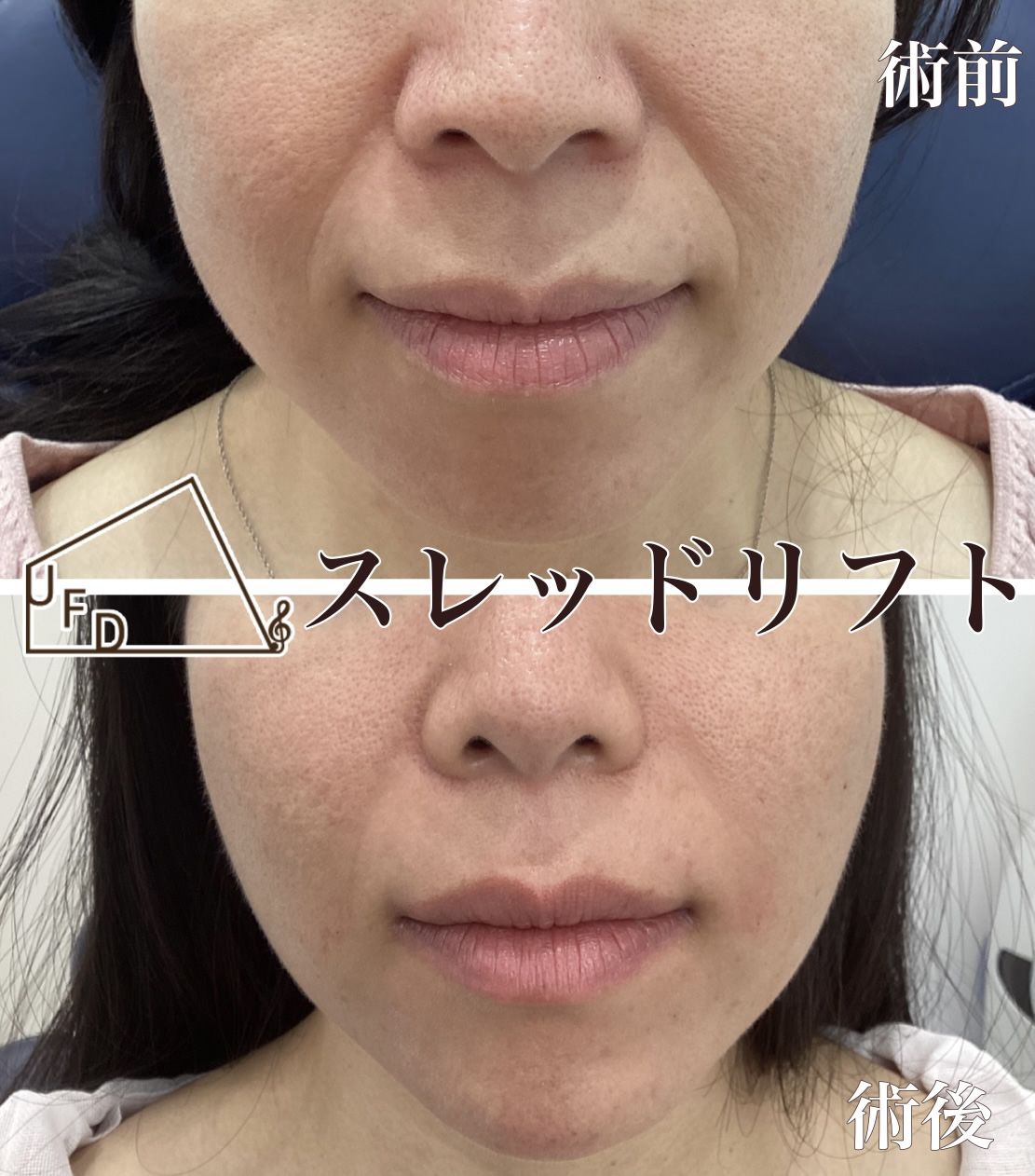 ほうれい線の症状3