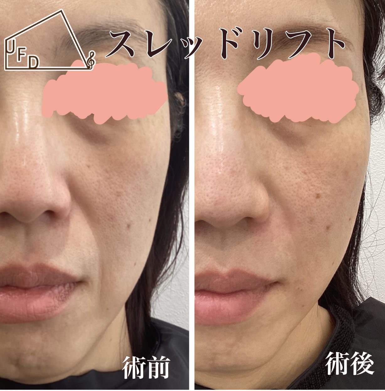 ほうれい線の症状4