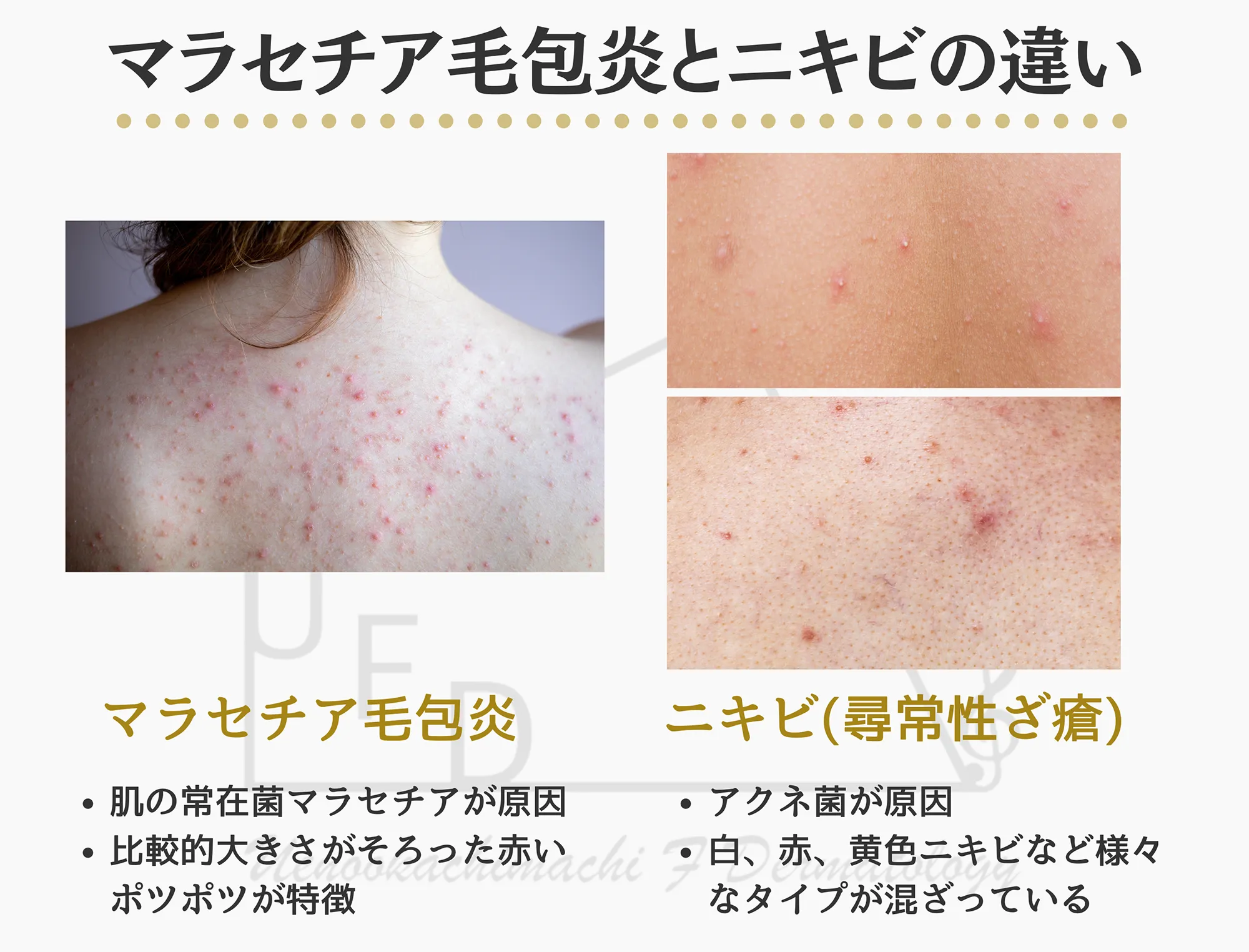 マラセチア毛包炎とニキビの違いについて解説
