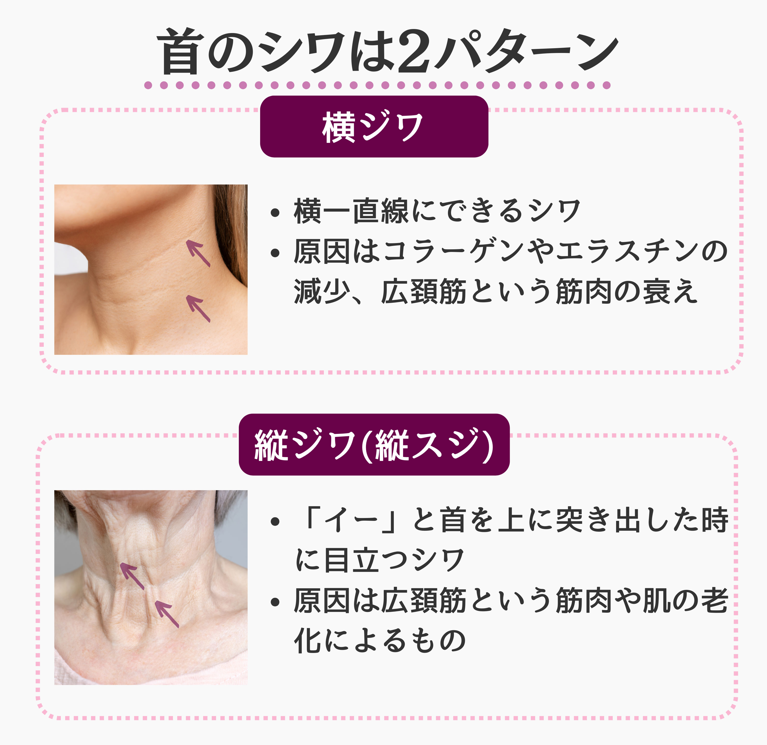 首のシワは2パターン