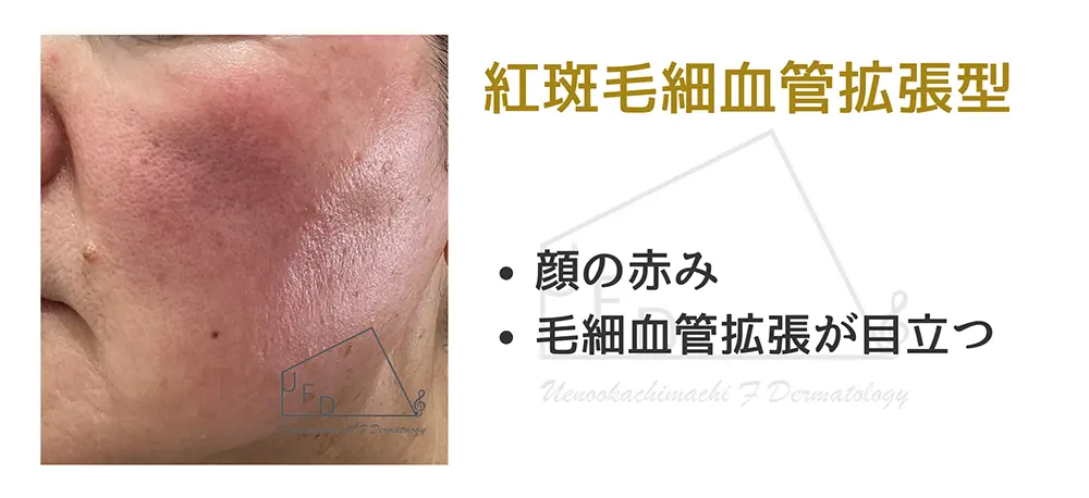 紅斑毛細血管拡張型の画像