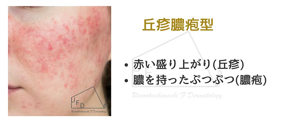 丘疹・膿疱型の画像