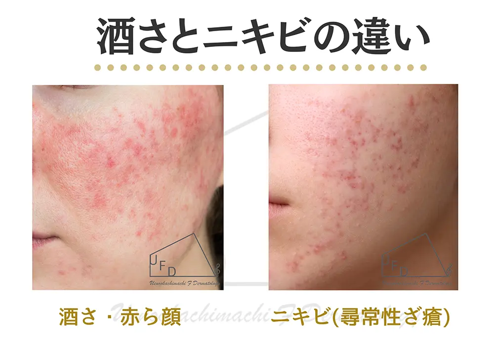 ニキビとの違い
