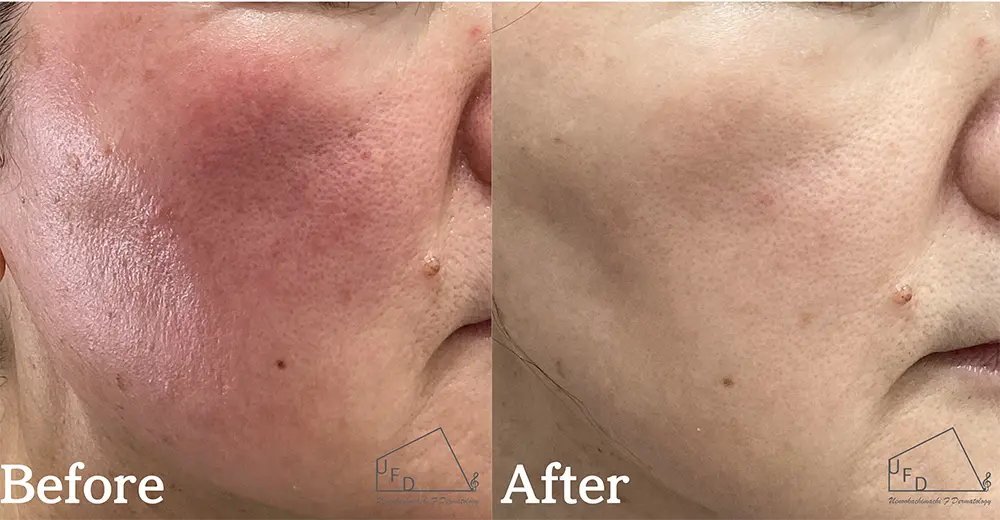 酒さ 赤ら顔症状写真5