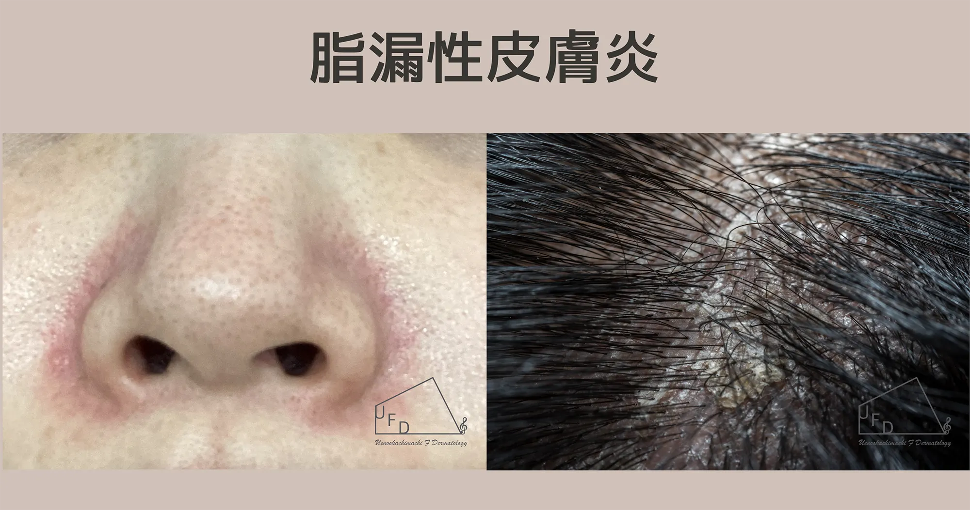 脂漏性皮膚炎治療について詳しく解説