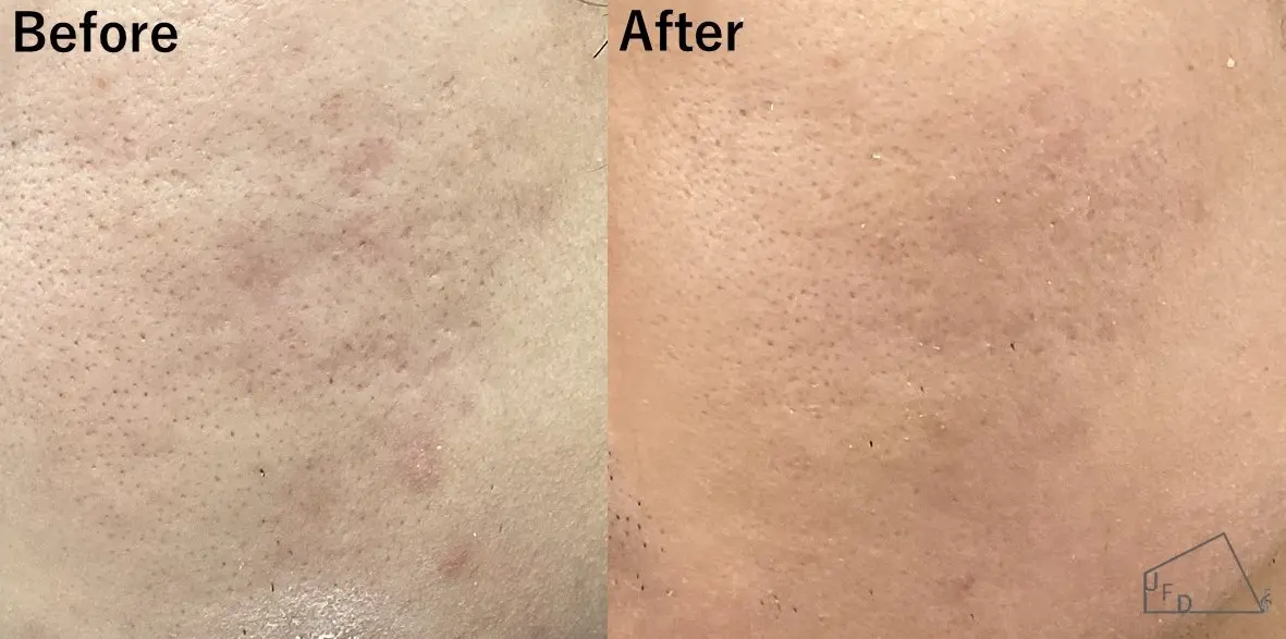 サブシジョン症例1