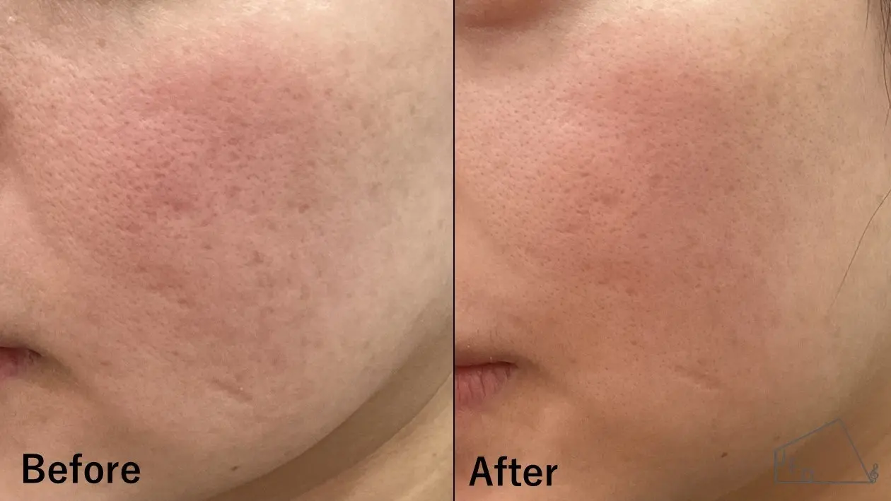 サブシジョン症例2