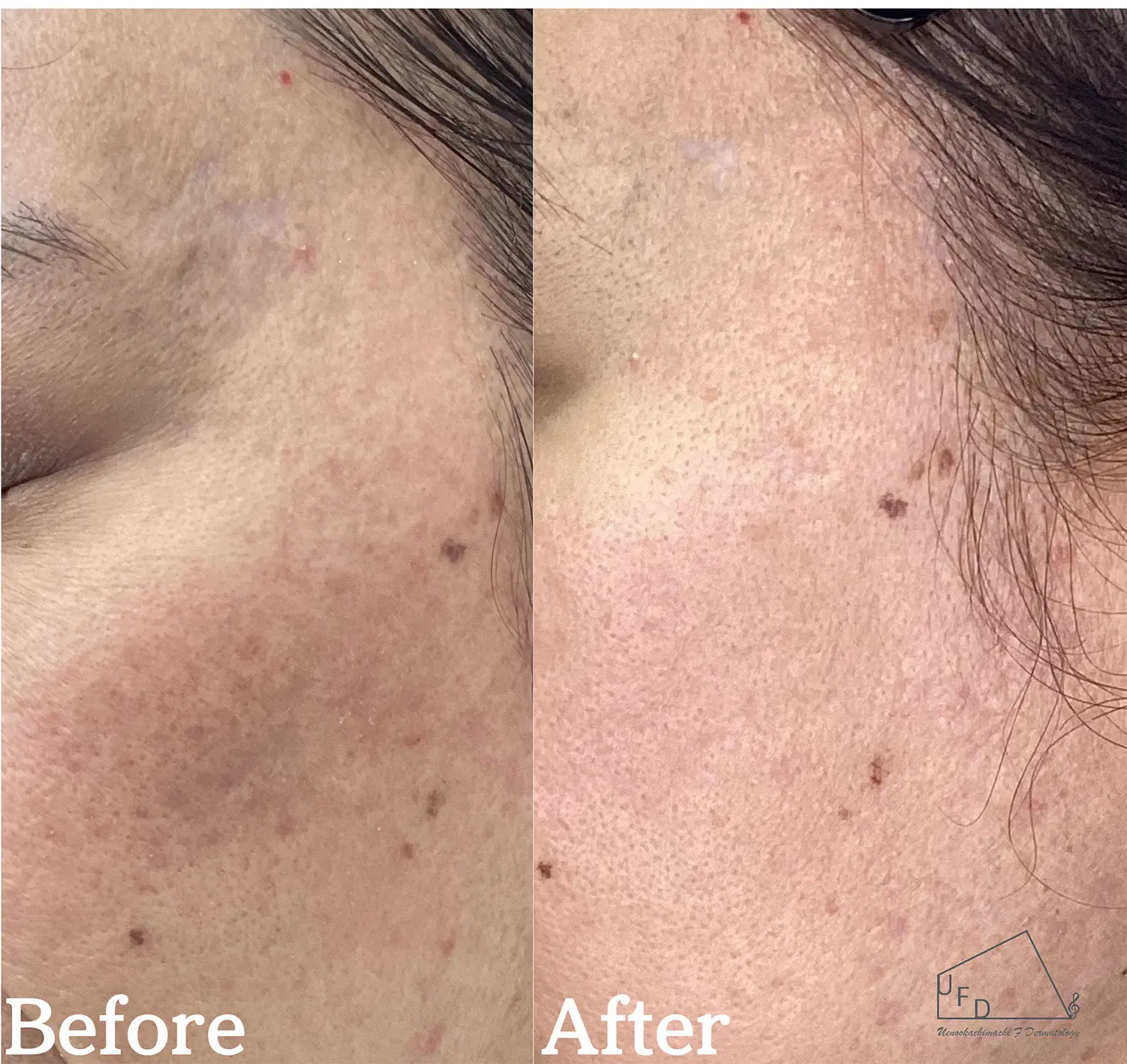 サブシジョン症例3