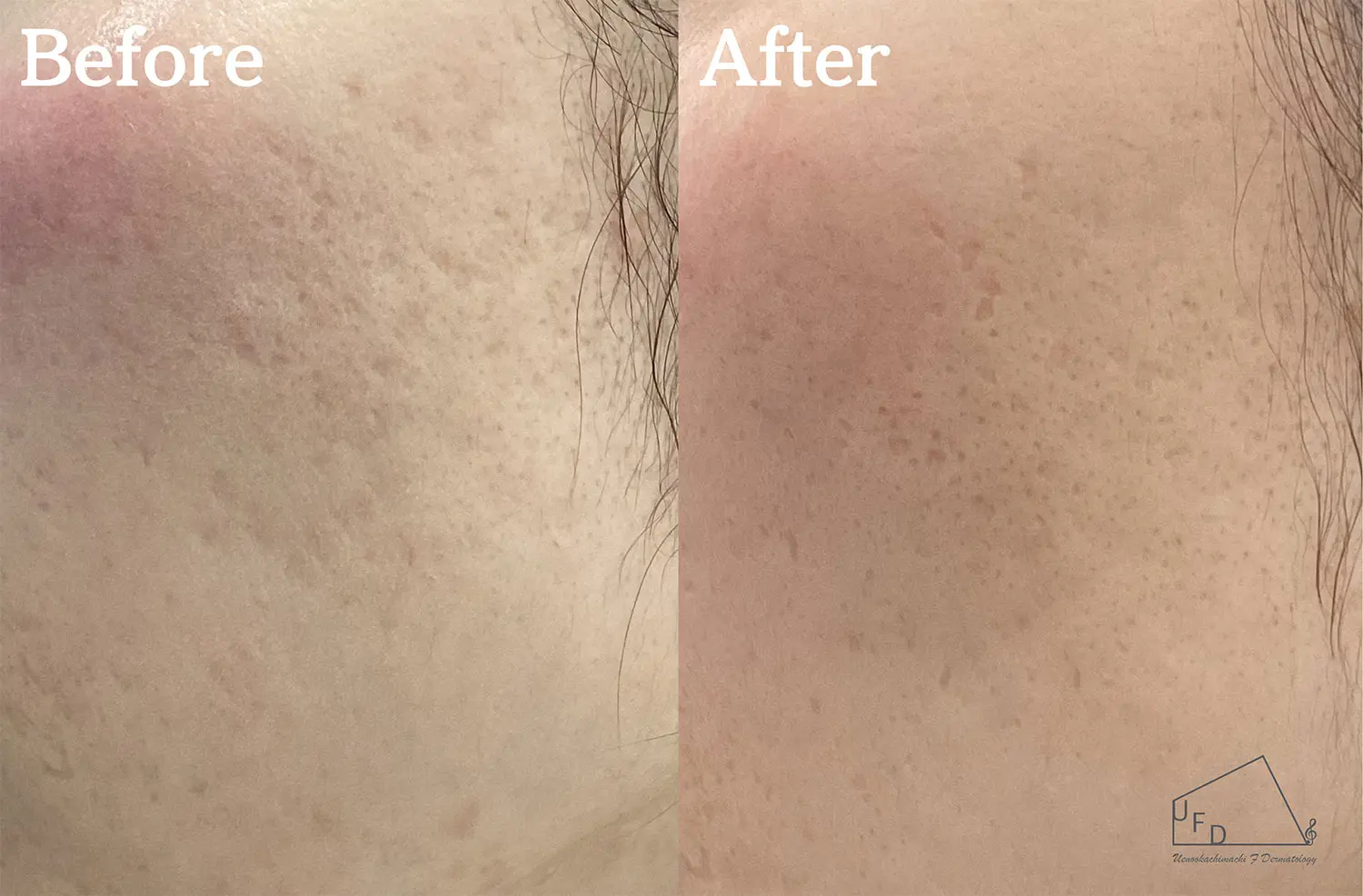 サブシジョン症例5