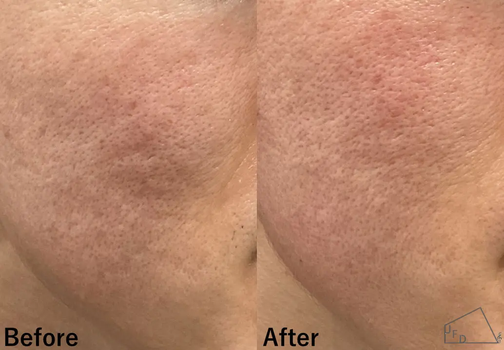 サブシジョン症例5