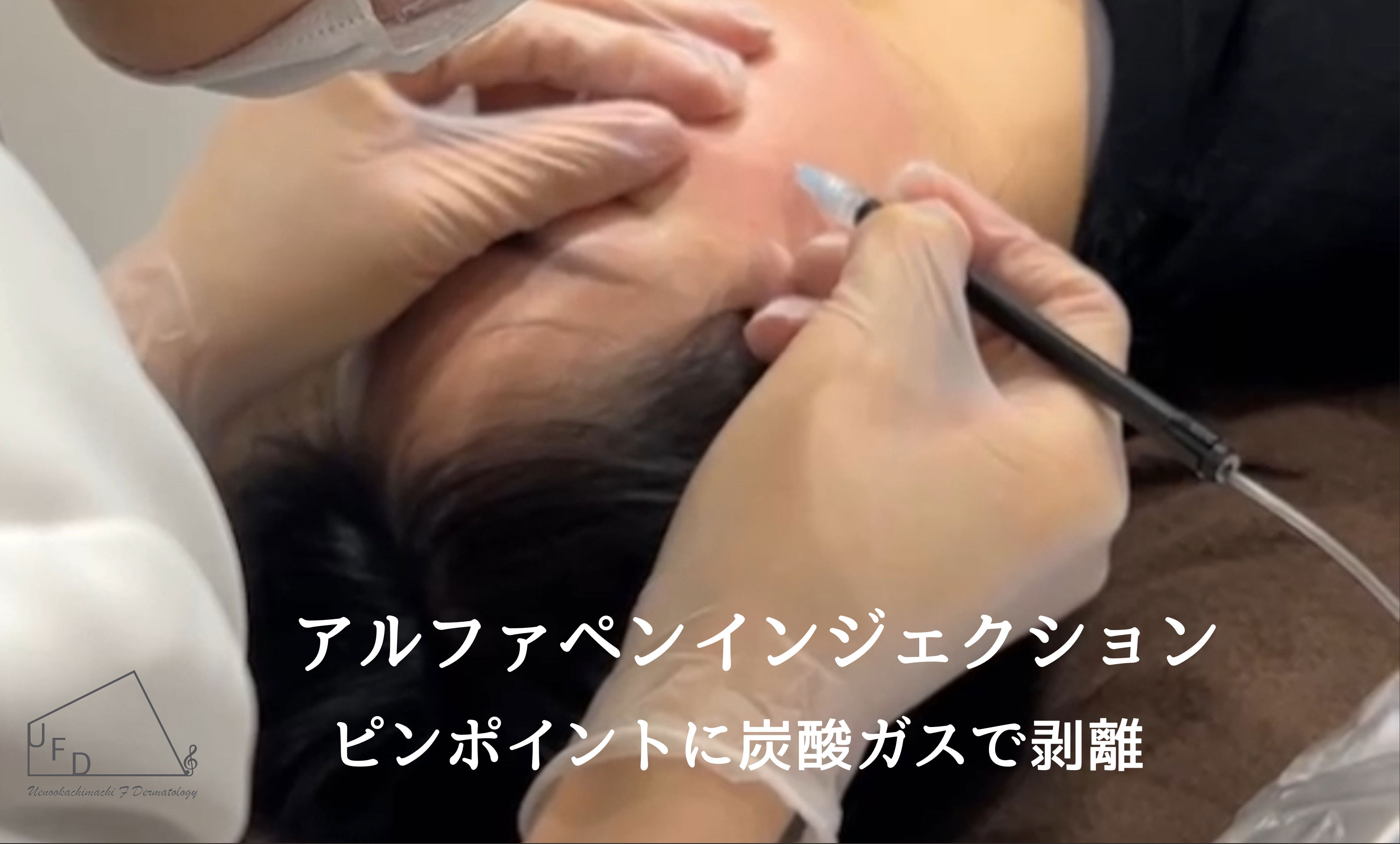 マニュアルインジェクション