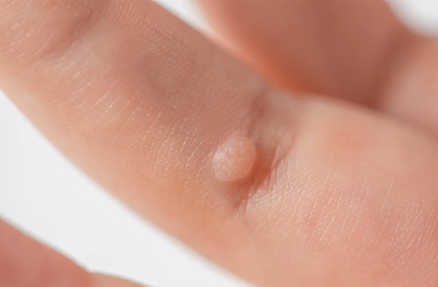 尋常性疣贅の患部写真