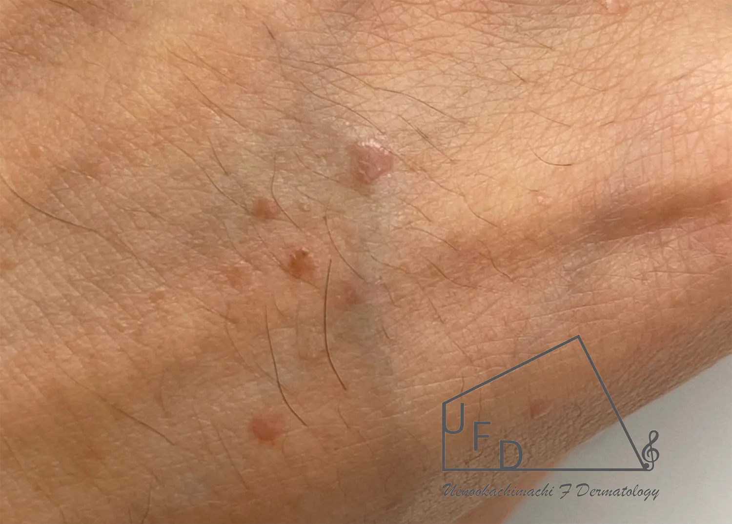 扁平疣贅の患部写真